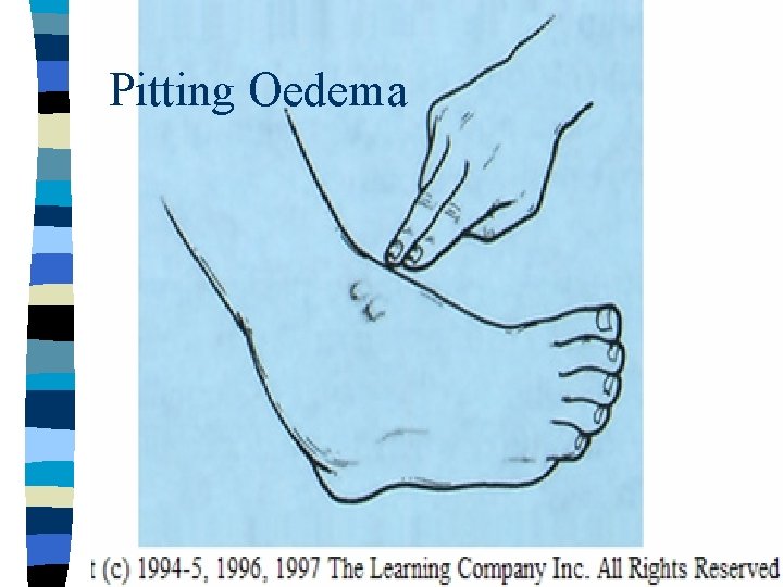 Pitting Oedema 