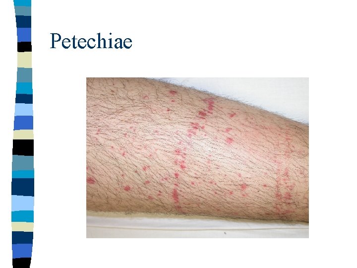 Petechiae 