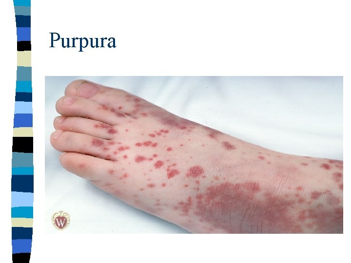 Purpura 