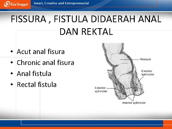 FISSURA , FISTULA DIDAERAH ANAL DAN REKTAL • • Acut anal fisura Chronic anal
