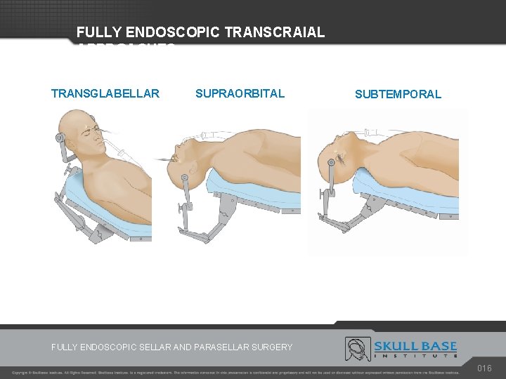 FULLY ENDOSCOPIC TRANSCRAIAL APPROACHES TRANSGLABELLAR SUPRAORBITAL SUBTEMPORAL FULLY ENDOSCOPIC SELLAR AND PARASELLAR SURGERY 016