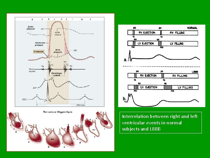 Interrelation between right and left ventricular events in normal subjects and LBBB 