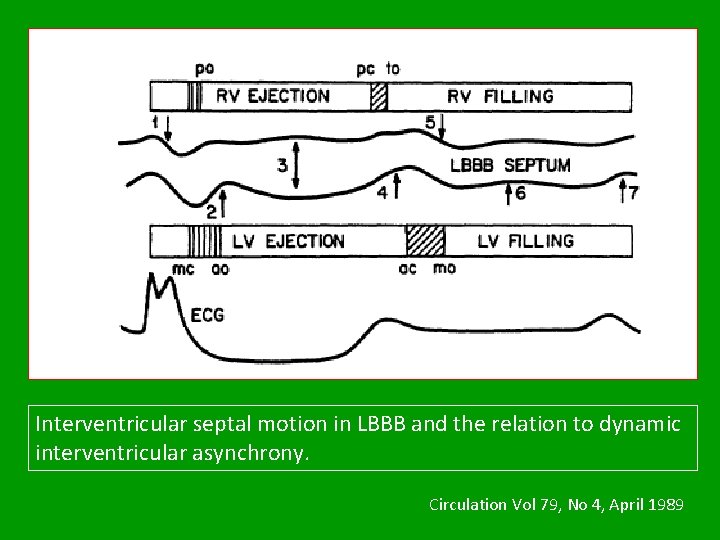 Interventricular septal motion in LBBB and the relation to dynamic interventricular asynchrony. Circulation Vol