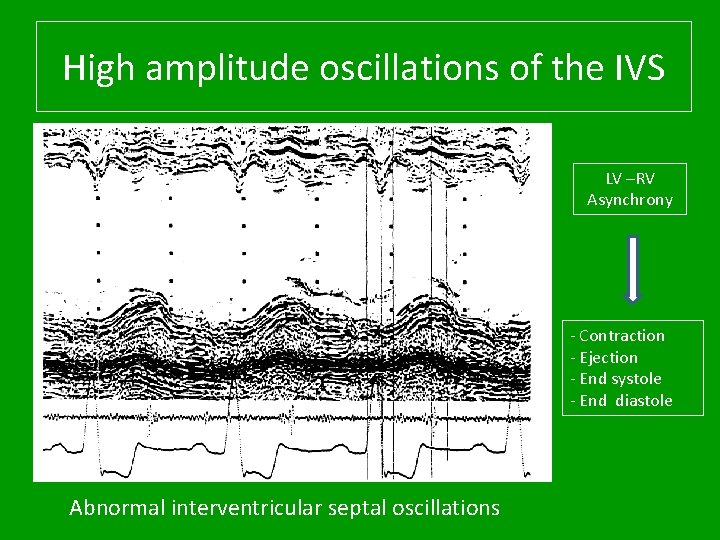 High amplitude oscillations of the IVS LV –RV Asynchrony - Contraction - Ejection -
