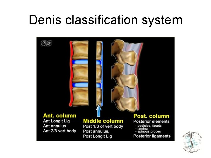 Denis classification system 