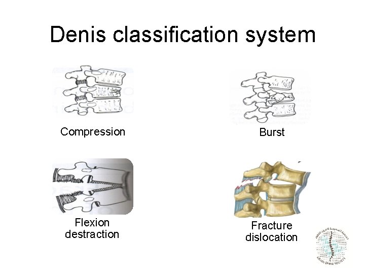 Denis classification system Compression Burst Flexion destraction Fracture dislocation 