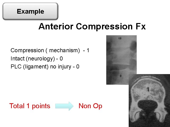 Example Anterior Compression Fx Compression ( mechanism) - 1 Intact (neurology) - 0 PLC