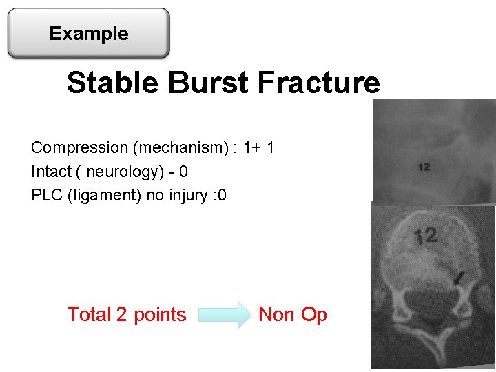 Example Stable Burst Fracture Compression (mechanism) : 1+ 1 Intact ( neurology) - 0