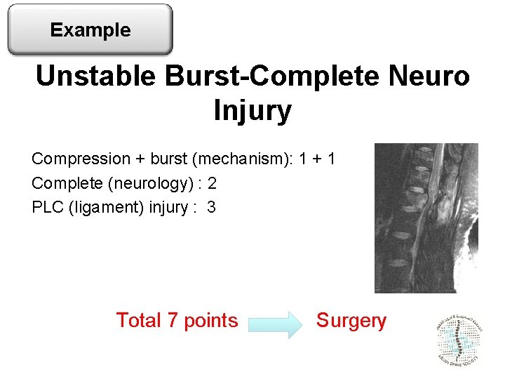 Example Unstable Burst-Complete Neuro Injury Compression + burst (mechanism): 1 + 1 Complete (neurology)