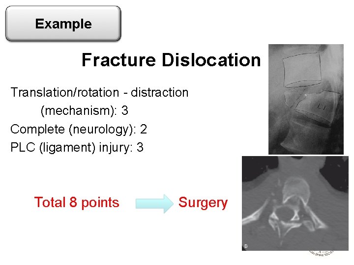 Example Fracture Dislocation Translation/rotation - distraction (mechanism): 3 Complete (neurology): 2 PLC (ligament) injury: