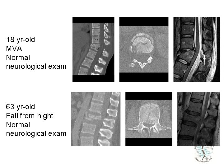 18 yr-old MVA Normal neurological exam 63 yr-old Fall from hight Normal neurological exam