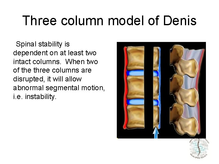 Three column model of Denis  Spinal stability is dependent on at least two intact