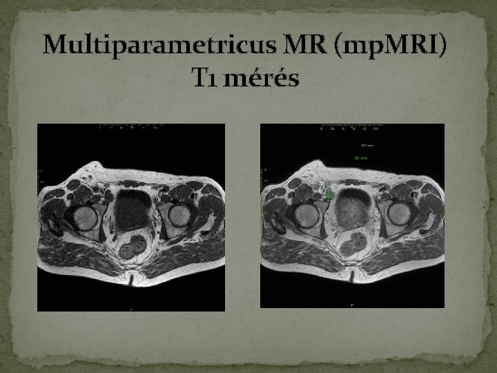 Multiparametricus MR (mp. MRI) T 1 mérés Multiparametricus MR (mp. MRI) T 1 mérés