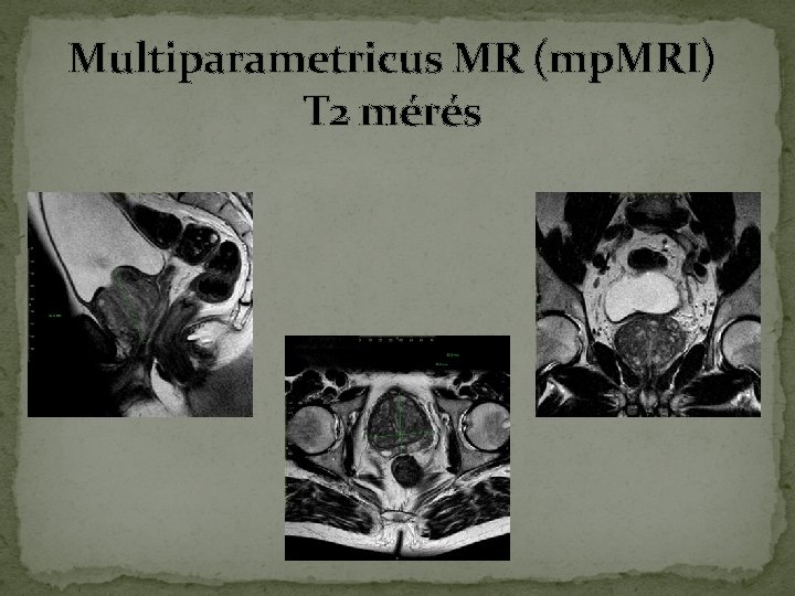 Multiparametricus MR (mp. MRI) T 2 mérés Multiparametricus MR (mp. MRI) T 2 mérés