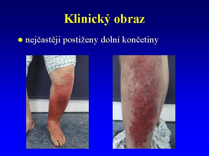 Klinický obraz l nejčastěji postiženy dolní končetiny 