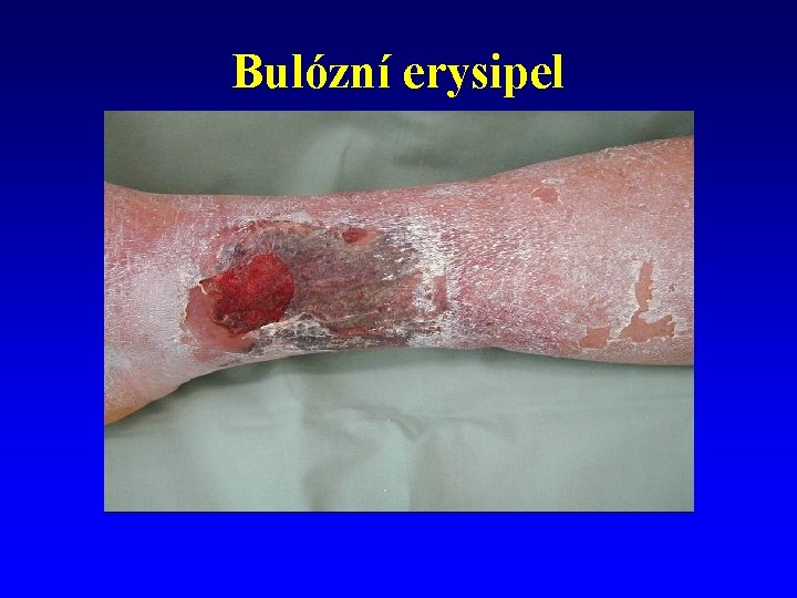 Bulózní erysipel 