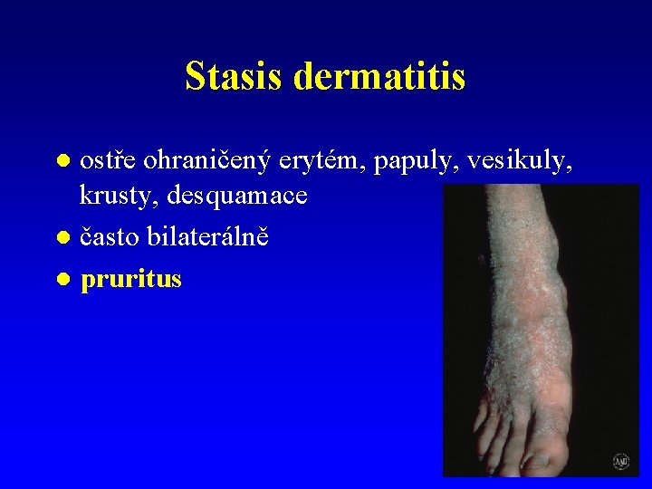 Stasis dermatitis ostře ohraničený erytém, papuly, vesikuly, krusty, desquamace l často bilaterálně l pruritus