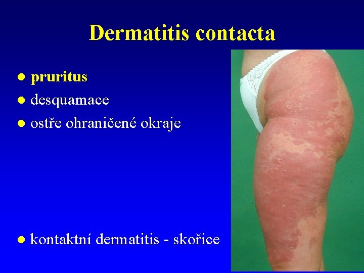 Dermatitis contacta pruritus l desquamace l ostře ohraničené okraje l l kontaktní dermatitis -