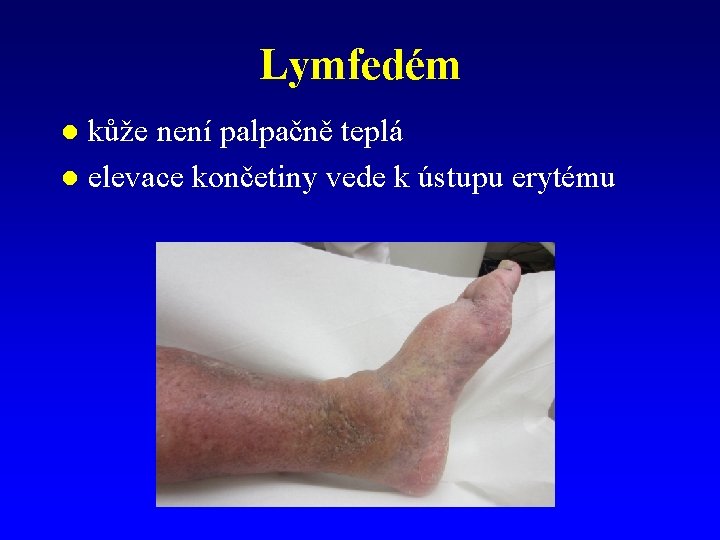 Lymfedém kůže není palpačně teplá l elevace končetiny vede k ústupu erytému l 