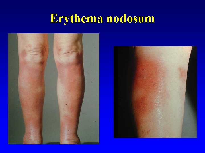 Erythema nodosum 