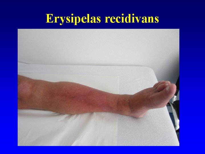 Erysipelas recidivans 