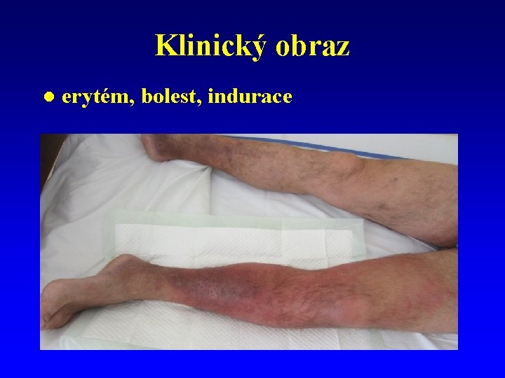 Klinický obraz l erytém, bolest, indurace 