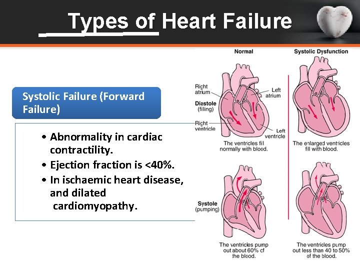 Types of Heart Failure Systolic Failure (Forward Failure) • Abnormality in cardiac contractility. •