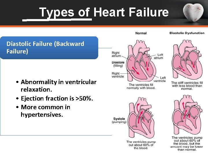 Types of Heart Failure Diastolic Failure (Backward Failure) • Abnormality in ventricular relaxation. •