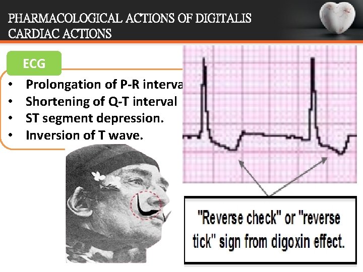 PHARMACOLOGICAL ACTIONS OF DIGITALIS CARDIAC ACTIONS • • ECG Prolongation of P-R interval Shortening