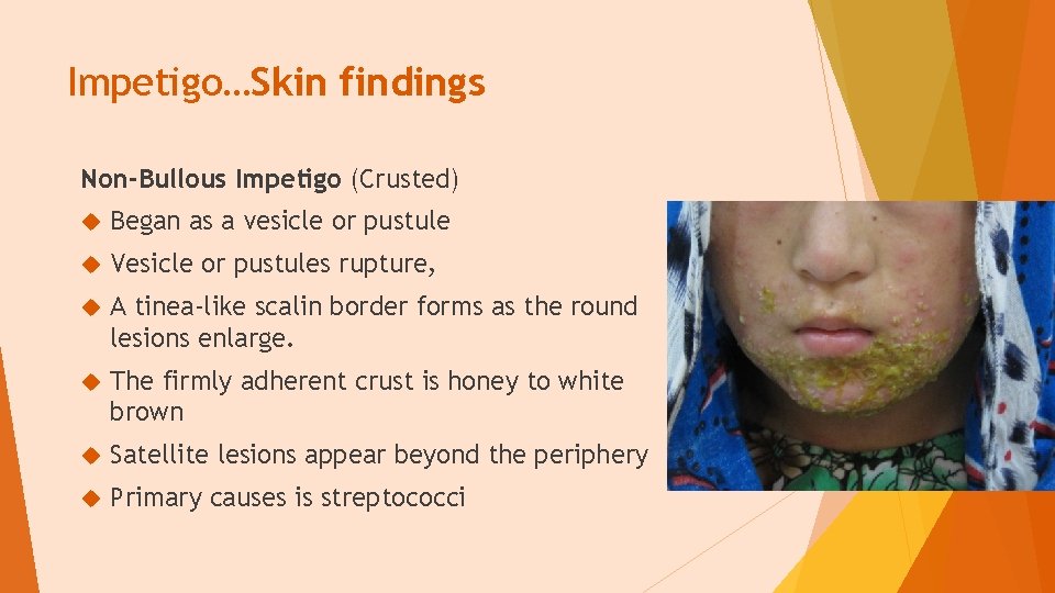 Impetigo…Skin findings Non-Bullous Impetigo (Crusted) Began as a vesicle or pustule Vesicle or pustules