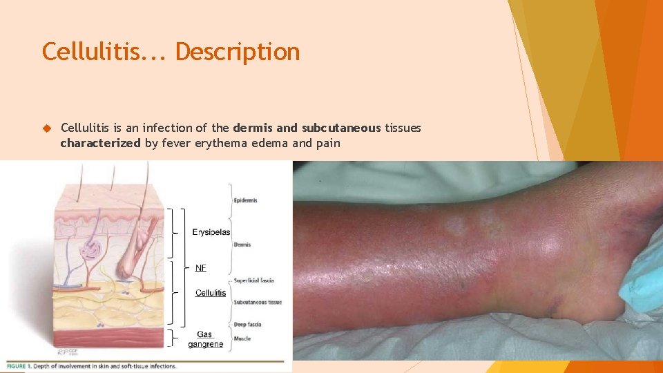 Cellulitis. . . Description Cellulitis is an infection of the dermis and subcutaneous tissues