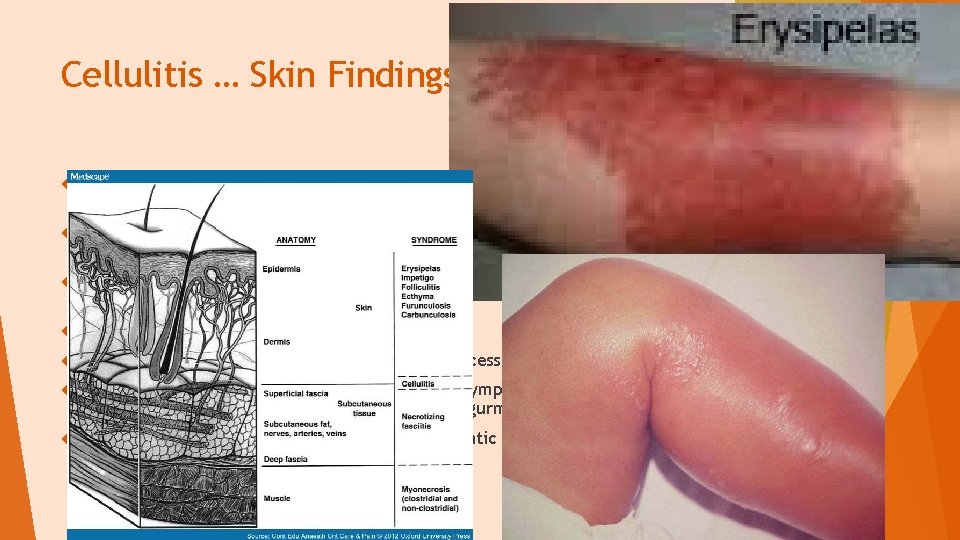 Cellulitis … Skin Findings A pre-existing lesion such as an ulecer, erosion may act
