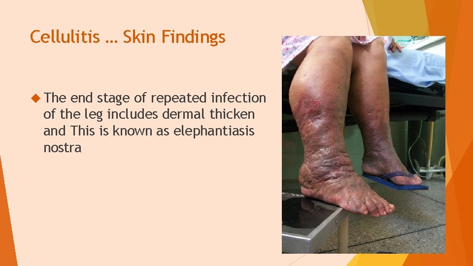 Cellulitis … Skin Findings The end stage of repeated infection of the leg includes