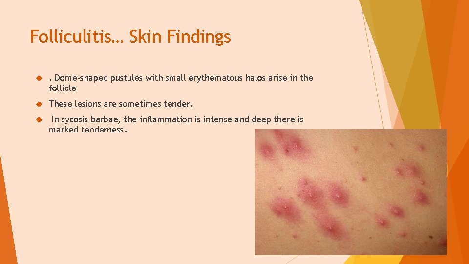 Folliculitis… Skin Findings . Dome-shaped pustules with small erythematous halos arise in the follicle