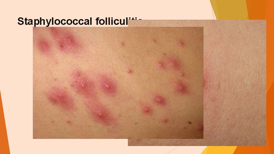 Staphylococcal folliculitis 