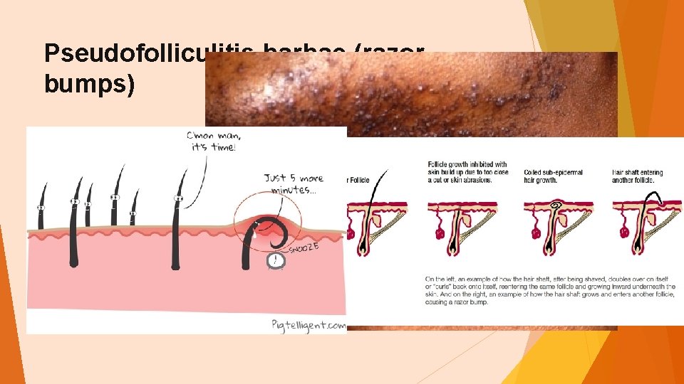 Pseudofolliculitis barbae (razor bumps) 
