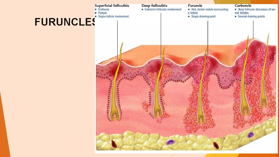 FURUNCLES AND CARBUNCLES 
