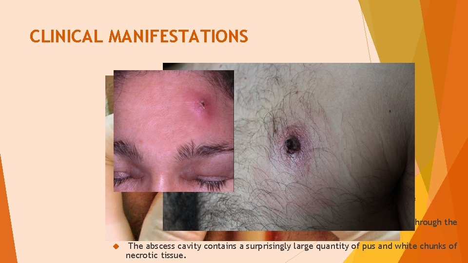 CLINICAL MANIFESTATIONS The lesion begins as a deep, tender, firm, red papule that enlarges