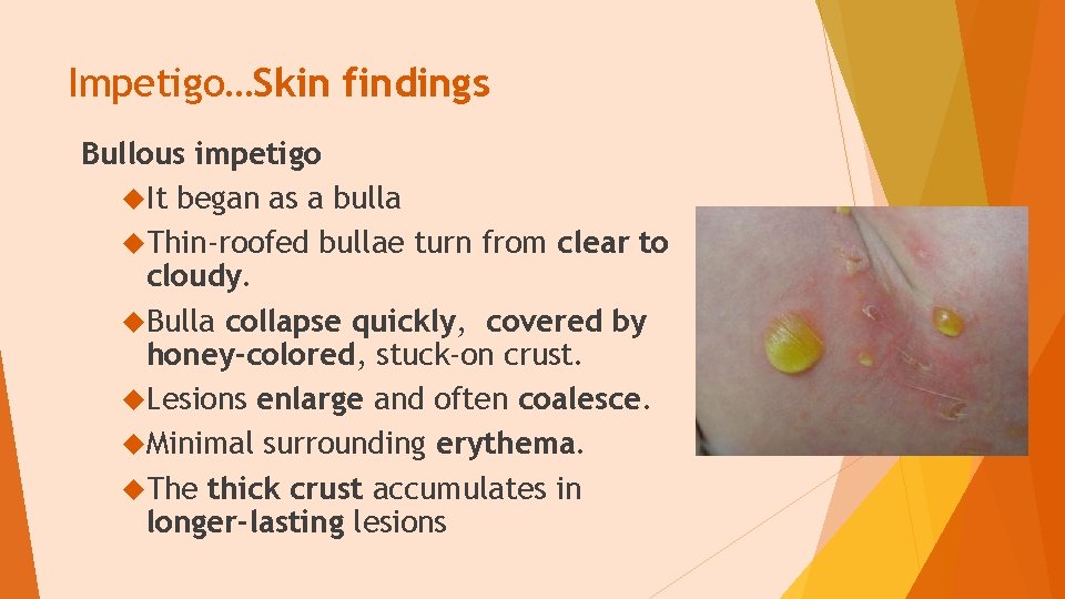 Impetigo…Skin findings Bullous impetigo It began as a bulla Thin-roofed bullae turn from clear