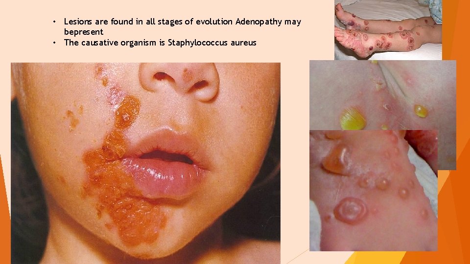  • Lesions are found in all stages of evolution Adenopathy may bepresent •