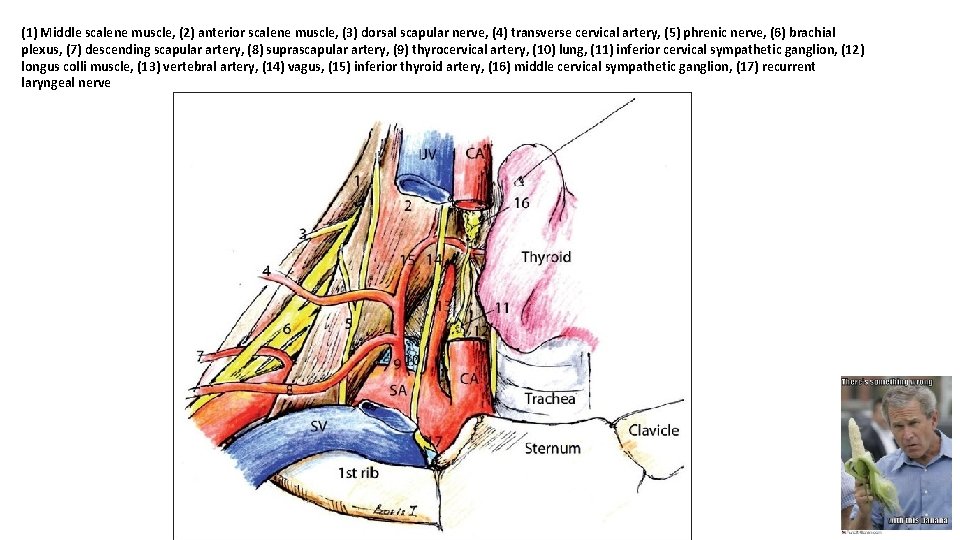 (1) Middle scalene muscle, (2) anterior scalene muscle, (3) dorsal scapular nerve, (4) transverse