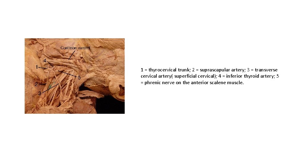 1 = thyrocervical trunk; 2 = suprascapular artery; 3 = transverse cervical artery( superficial