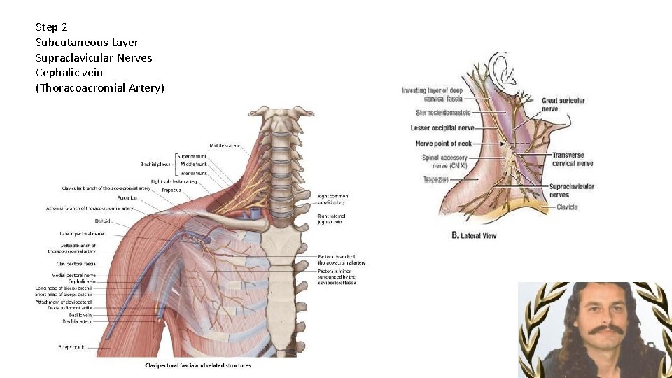 Step 2 Subcutaneous Layer Supraclavicular Nerves Cephalic vein (Thoracoacromial Artery) 
