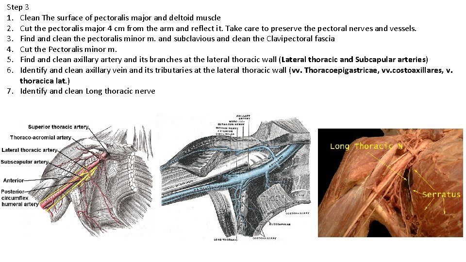 Step 3 1. Clean The surface of pectoralis major and deltoid muscle 2. Cut