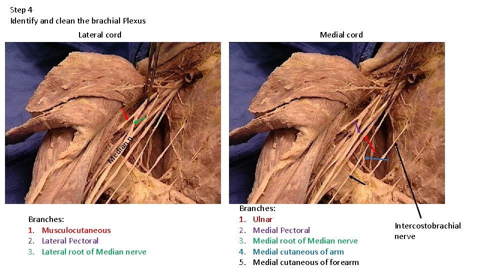 Step 4 Identify and clean the brachial Plexus Medial cord M ed ian n.