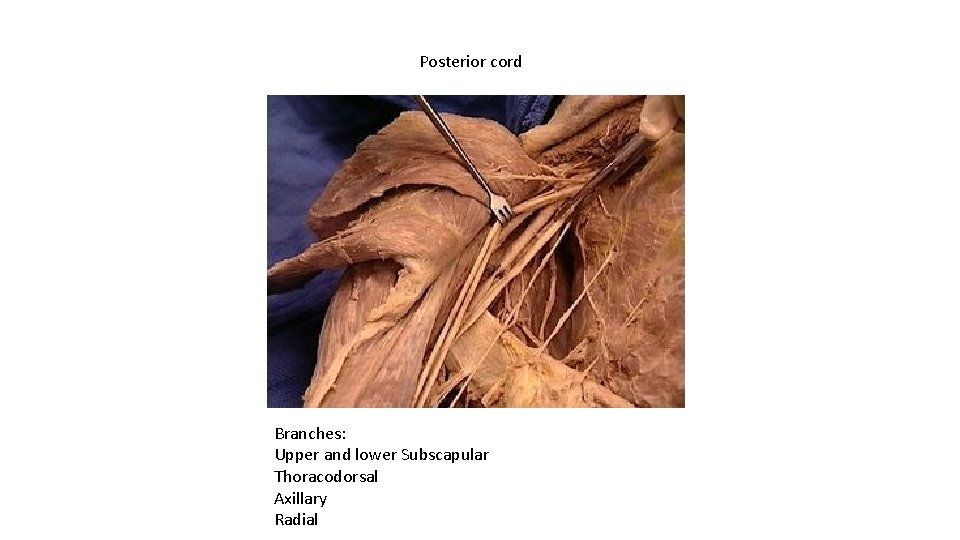 Posterior cord Branches: Upper and lower Subscapular Thoracodorsal Axillary Radial 