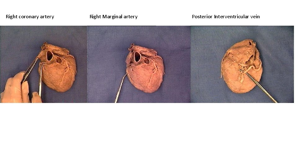 Right coronary artery Right Marginal artery Posterior Interventricular vein 