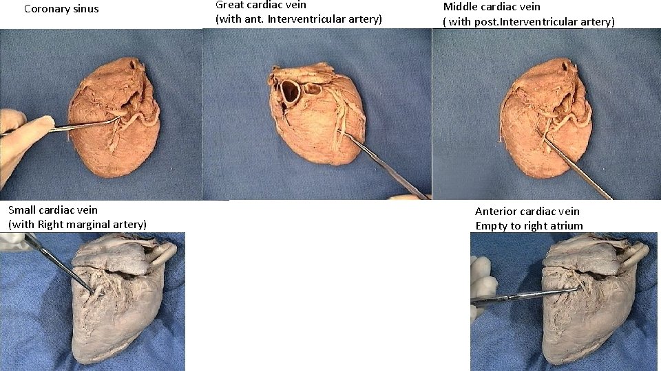 Coronary sinus Small cardiac vein (with Right marginal artery) Great cardiac vein (with ant.