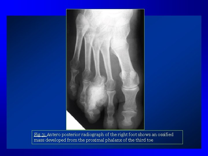 Fig 3: Antero posterior radiograph of the right foot shows an ossified mass developed