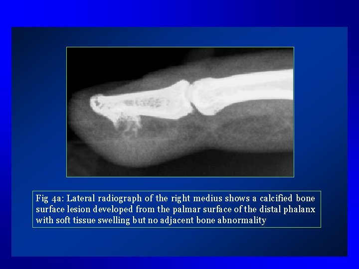 Fig 4 a: Lateral radiograph of the right medius shows a calcified bone surface